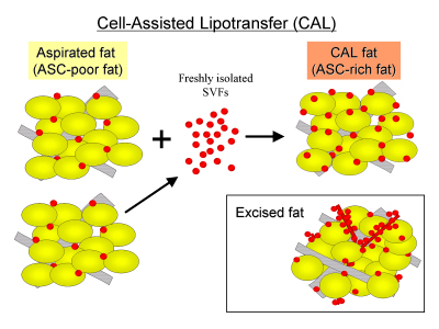 顔の脂肪萎縮症の治療のための脂肪移植 - All Stem Cells JapanAll 