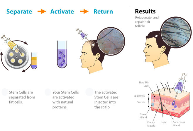 Diagram_Hair_Loss