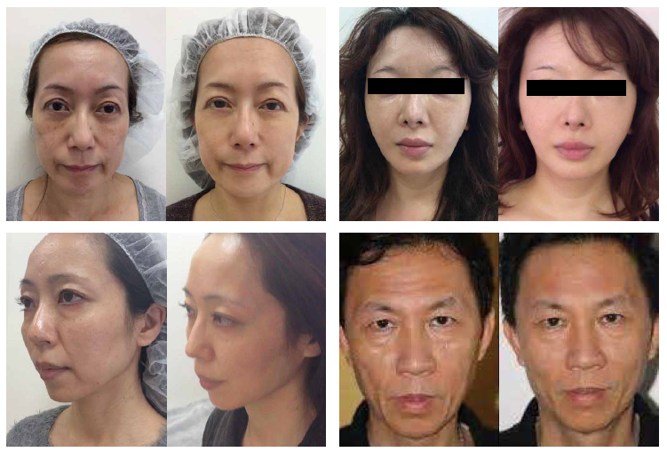 cases of stem cell anti-aging treatment